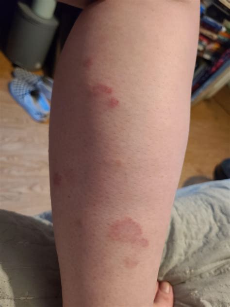 I develop this rash on my left leg every time I'm feeling sick. It's