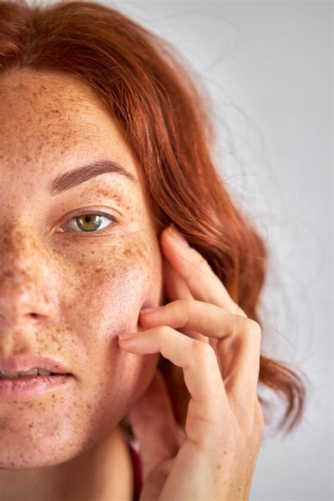 Birthmark on Face Meaning: Chin, Cheek, Lip, and Nose