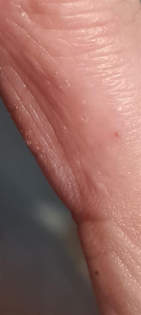 Small bumps on insides of fingers : r/medical_advice