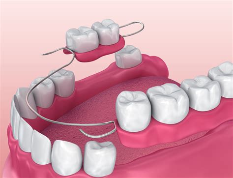 Types Of Removable Partial Denture Clasps - Design Talk