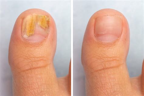 Early Stages of Toenail Fungus: Symptoms, Causes and Treatments ...