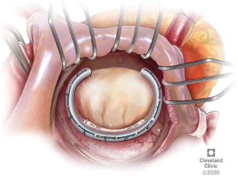 How To Fix A Leaky Mitral Valve at Andrew Leichhardt blog