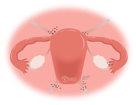 Endometriosis — OMIG