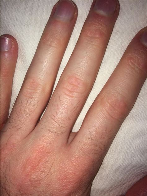 8 best r/dermatomyositis images on Pholder | Been having chronic muscle