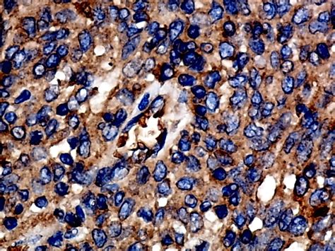 MMP12 serves as an immune cell–related marker of disease status and ...