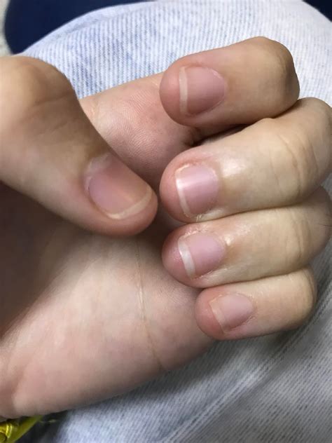 callused skin on fingertips? : r/nailbiting