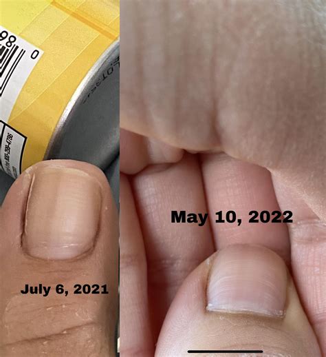 Does this look like subungual melanoma/nail cancer? : DiagnoseMe