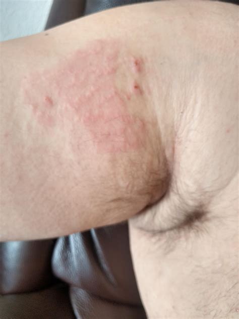 BF Flare-Up: any suggestions?? (pics included) : r/eczema