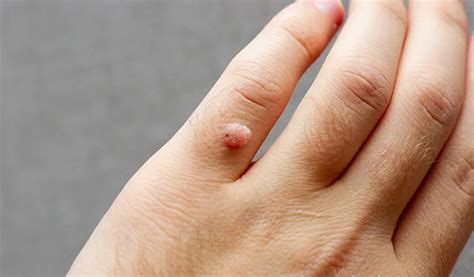 4 Types of Warts and Their Effective Treatments