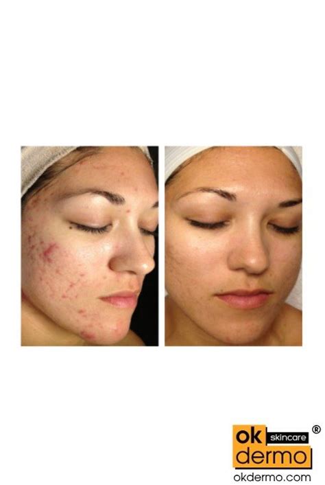 ClearGel® Clindamycin Gel | OKDERMO Skin Care