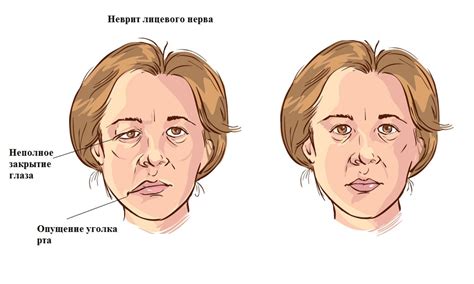 Лечение неврита лицевого нерва — как лечить неврит нерва лица, клиника ...