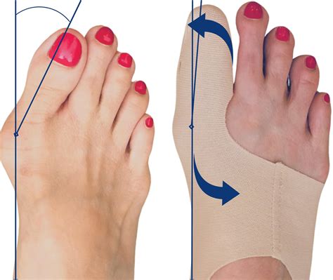 Buy Bunion Corrector for Women Big Toe Straightener - Ultra-Thin Bunion