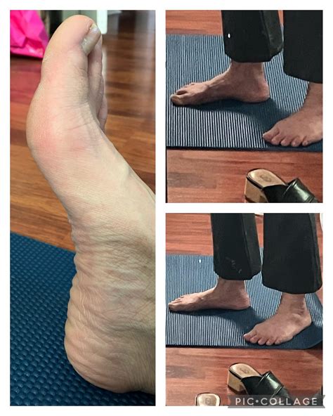 Are these high or low arches? Trying to figure out inserts for PF : r