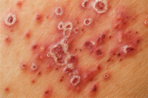 genital herpes  symptoms diagnosis  treatment