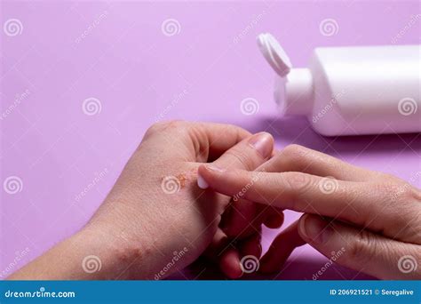 Women S Hands with Eczema Apply the Cream To the Damaged Skin of the ...