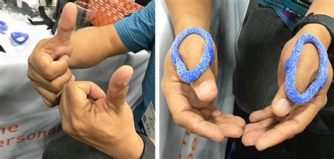 Orthotic Fabrication for MCP Joint Instability