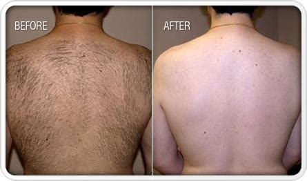 how to prevent body hair growth