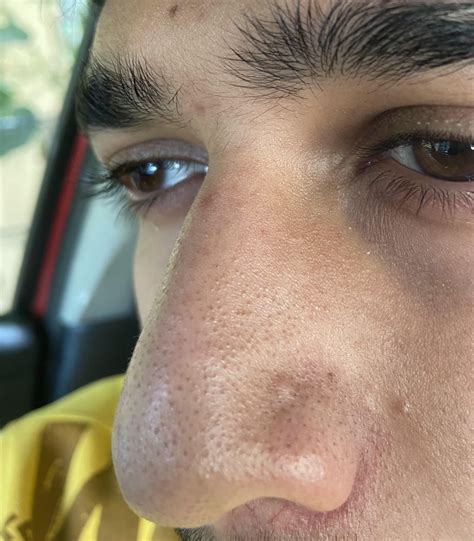 Experts Reveal The #1 Cause Of Stubborn Big Blackheads