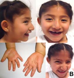 Angelman syndrome - Entireweb Search Engine
