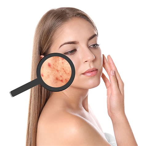 Профессиональное лечение акне - BarbaraBeauty