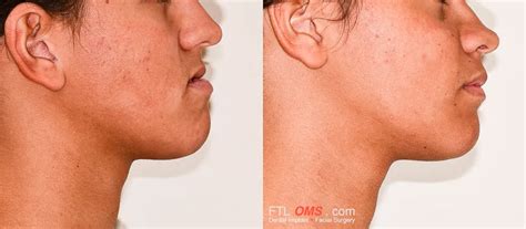 how to fix small lower jaw without surgery