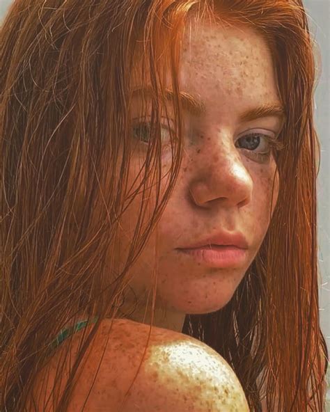 Freckles