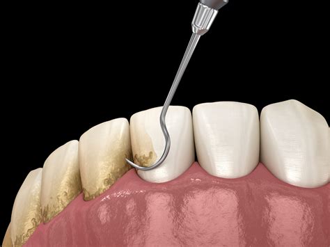 Keeping Gums Healthy With Ultrasonic Scaling | Londonderry, NH