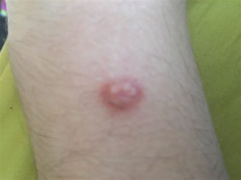 Red bump on top of wrist, began itching : r/skincancer