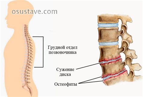 Остеохондроз 3 степени: шейного, грудного, поясничного отдела, симптомы ...