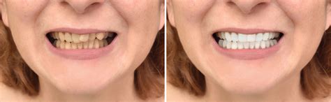 Before And After Teeth Images – Browse 3,169 Stock Photos, Vectors, and ...