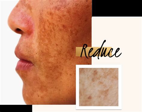 uneven complexion  pigmentation define clinic