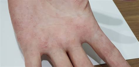 ตุ่มน้ำใสที่มือ Dyshidrosis พบได้บ่อย ทั้งในคนเป็นภูแพ้ และคนทั่วไปครับ ...