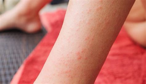 Celiac Disease, Symptoms & Treatment - Stress and Your Health