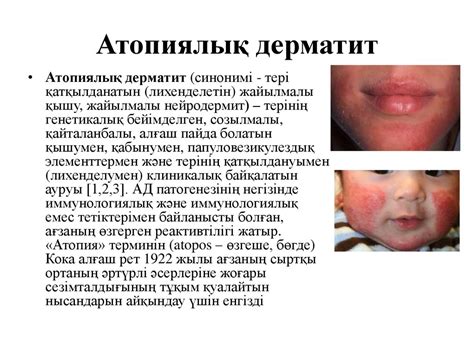 Атопиялық дерматит - презентация онлайн