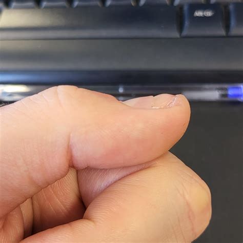 Partial nail loss journey : r/MakeMeSuffer