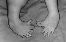 Thalidomide - Wikipedia