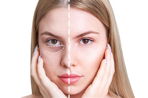 dark circles treatment dark circles treatment  dubai