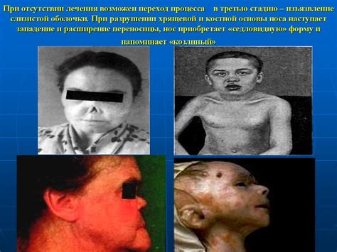 Врожденный сифилис - презентация онлайн
