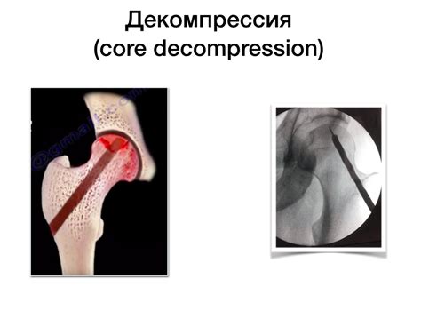 Асептический некроз