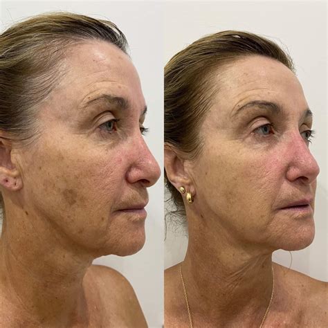 Elaine Brennan Peel Brisbane | Injex Clinics