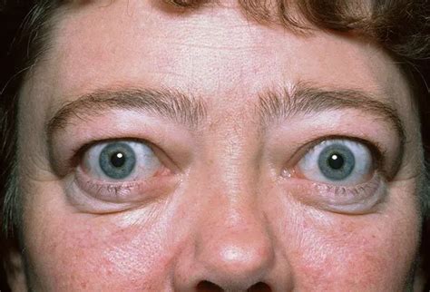 graves disease fatal eye symptoms treatment diagnosis diet
