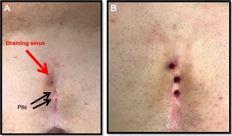 Updates on the Management of Pilonidal Disease - Advances in Pediatrics