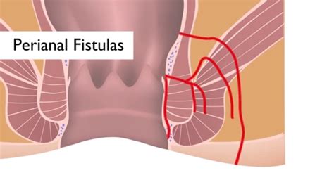 Fistula - 131 Fistula Illustrations Clip Art : Treatment options ...