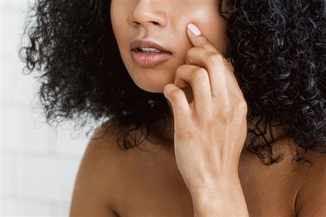 Pop cystic pimple risks could lead to permanent skin scarring