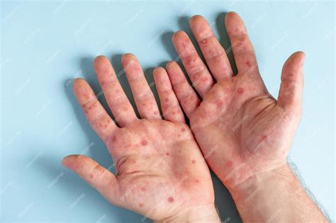 Болезнь обезьяны. пациент с сыпью обезьяньей оспы на руке. закрыть сыпь ...