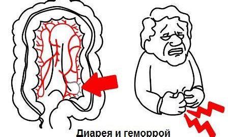 Как проявляется геморрой у мужчин и женщин