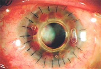 Artificial cornea: Good or bad? | Corneal transplant, Mumbai india, Corneal