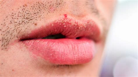 diagnosis treatment  hpv bumps  lips