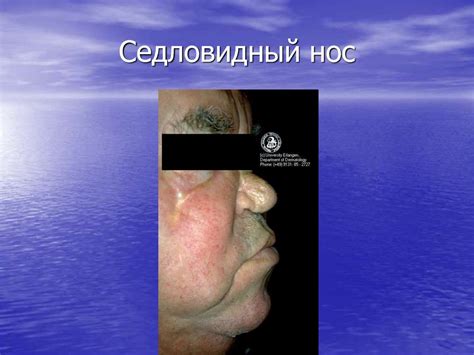 Третичный период сифилиса. Врожденный сифилис - презентация онлайн