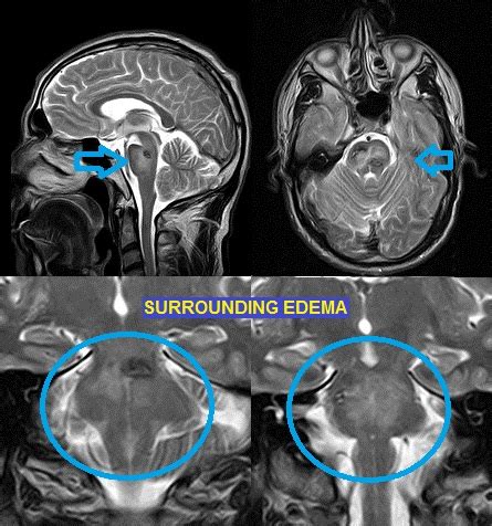 POINT OF VIEW: DX: Pontine cavernoma (deep cavernoma)
